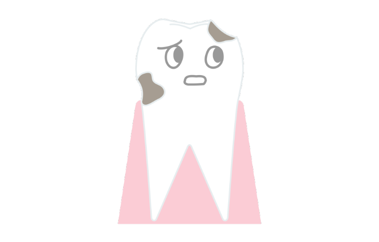 進行した虫歯