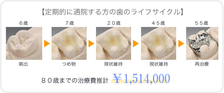 予防歯科の有無で生じる歯とコストの違い