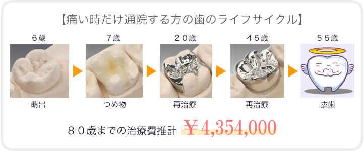 予防歯科の有無で生じる歯とコストの違い